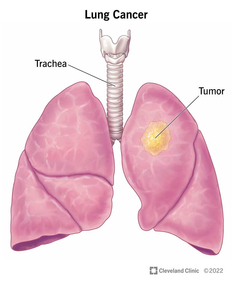 Lung